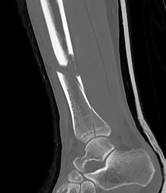 Distal tibia 3